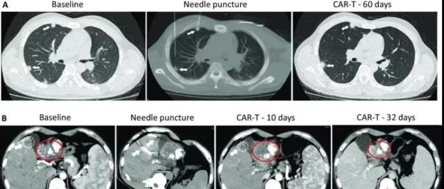 What immunotherapy can treat solid tumors more effectively in future?