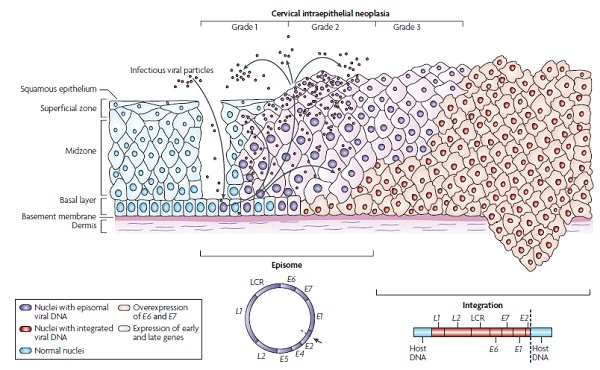 HPV DNA检测新方法：以致癌基因E6/E7作靶点，避免漏检